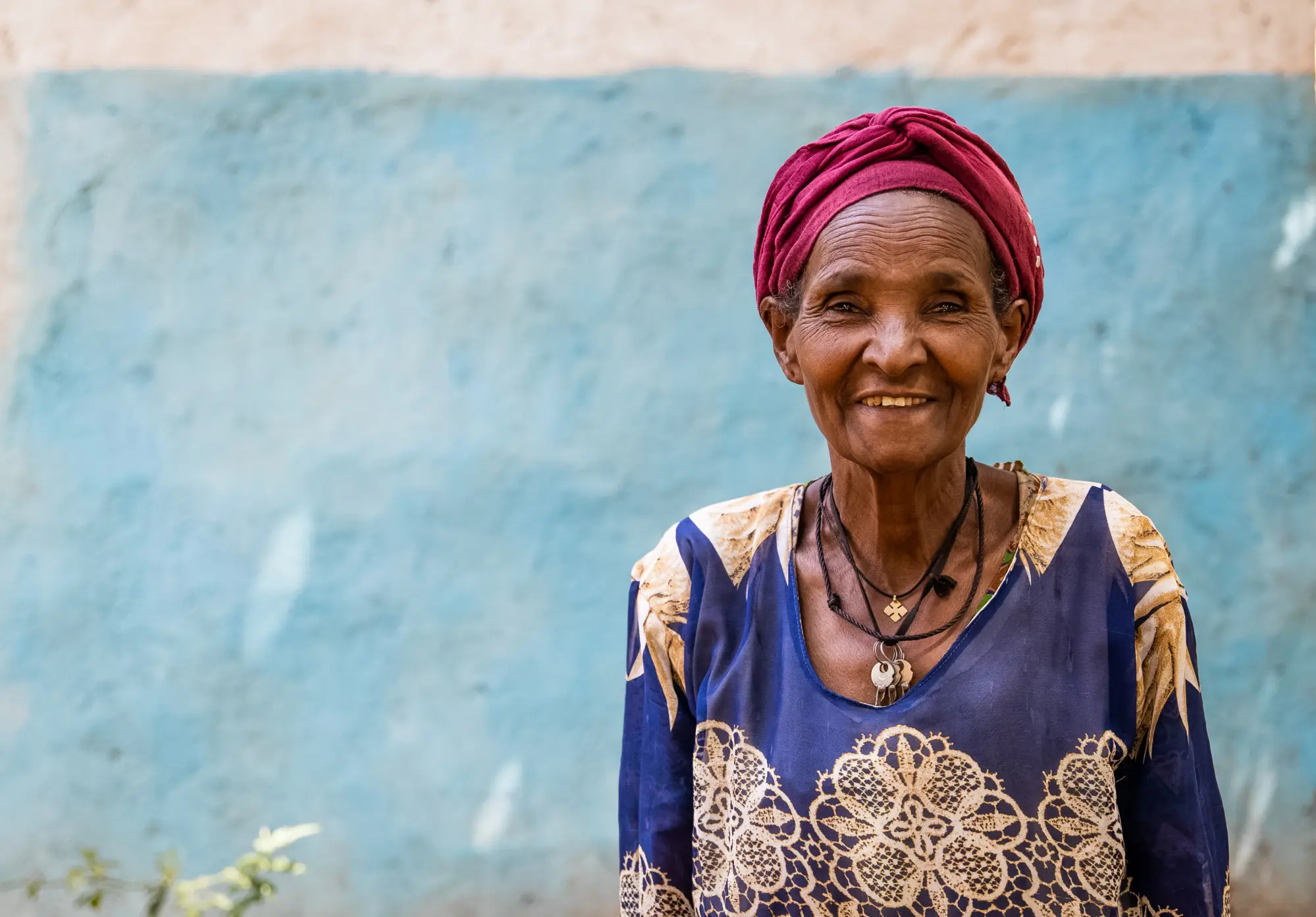 Lenkere Lema, podoconiosis patient, at her home in  Wadae Kero kebele, Sodo zuriya, Wolayita, Southern Ethiopia regional state