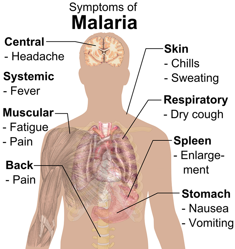 Symptoms of Malaria (By Mikael Häggström (All used images are in public domain.) via Wikimedia Commons)